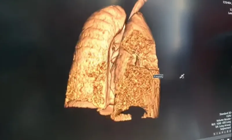 Pluca oboljelog