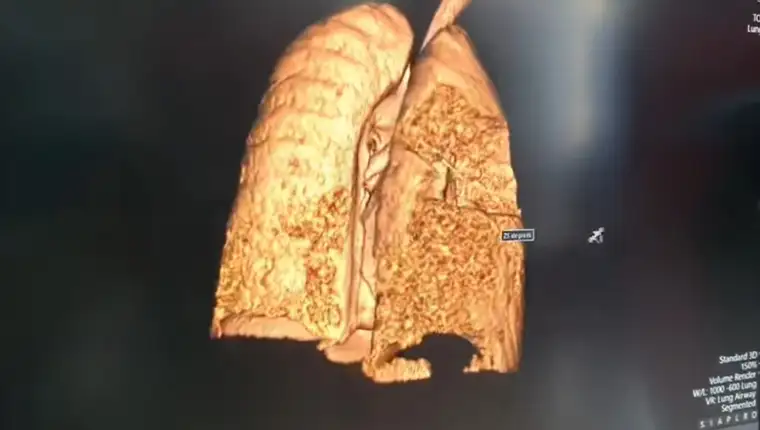 Pluca oboljelog