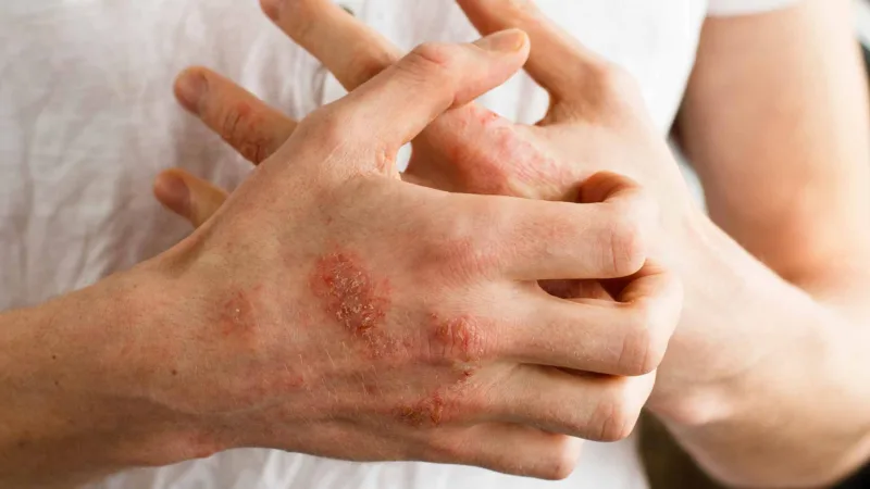 psorijaza