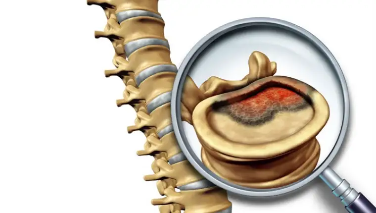 bone-cancerdc1bb37849bf63eeab9aff0f00dba087