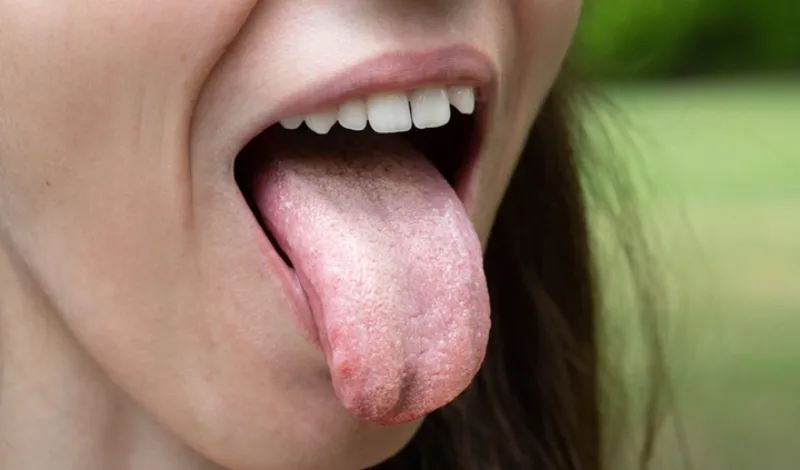 Female with tongue out of mouth showing Candida albicans infection