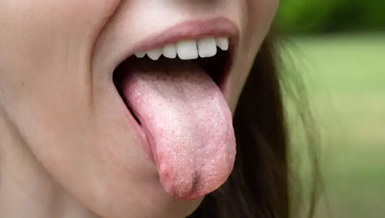 Female with tongue out of mouth showing Candida albicans infection