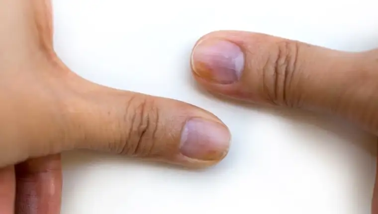 nokti