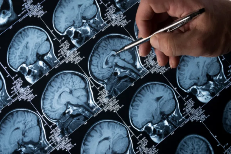 alzheimer1