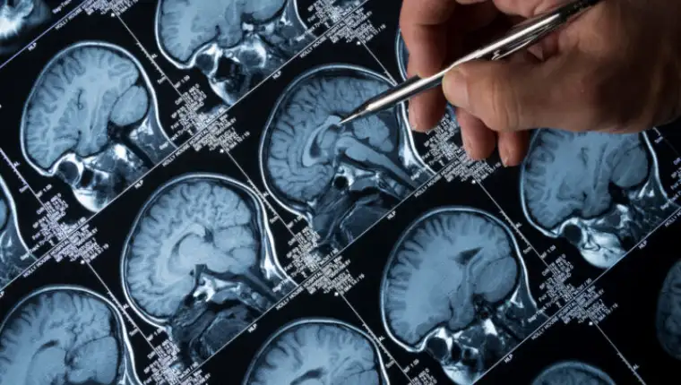 alzheimer1