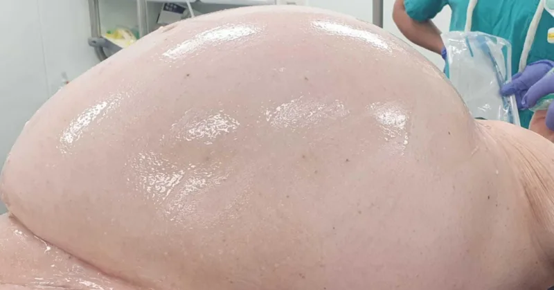 tumor