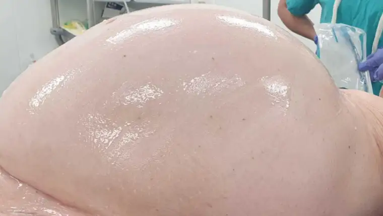 tumor