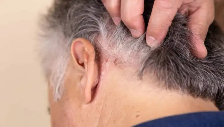 psorijaza