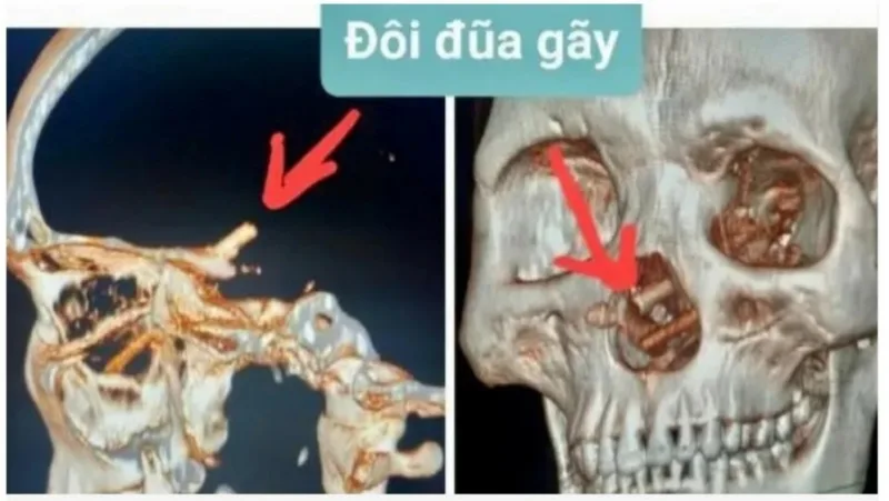 štapići za jelo u mozgu