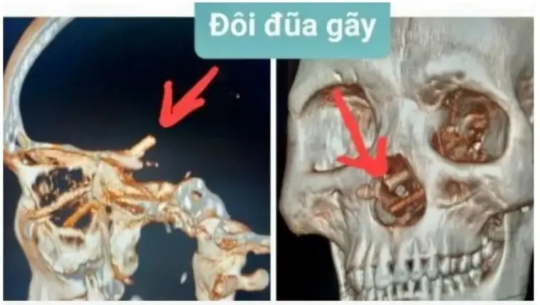 štapići za jelo u mozgu