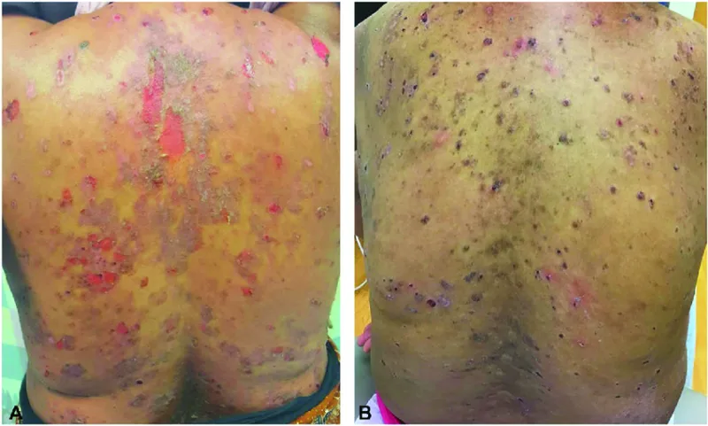 A-Pemphigus-vulgaris-Deep-erosions-and-crust-involving-the-back-B-Pemphigus