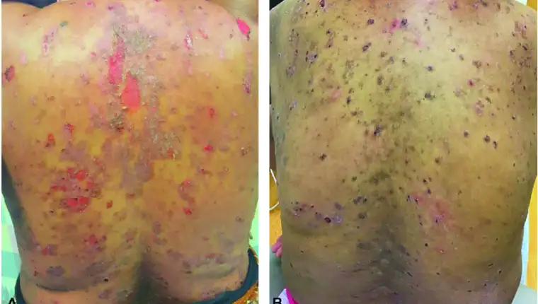 A-Pemphigus-vulgaris-Deep-erosions-and-crust-involving-the-back-B-Pemphigus