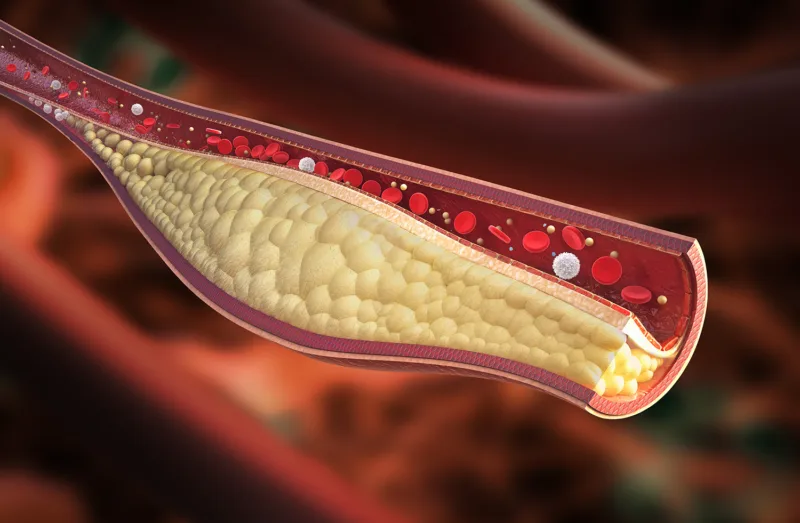 Vein - stable atherosclerotic plaque
