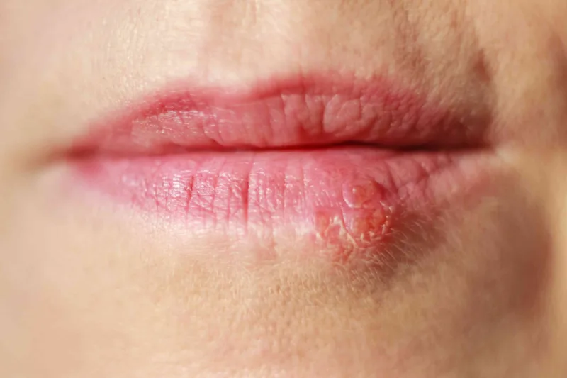 herpes