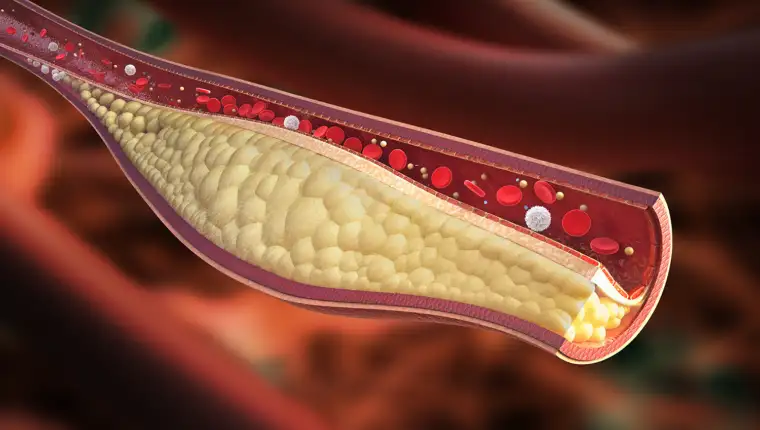 Vein - stable atherosclerotic plaque