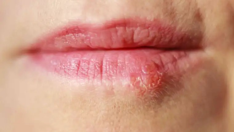 herpes