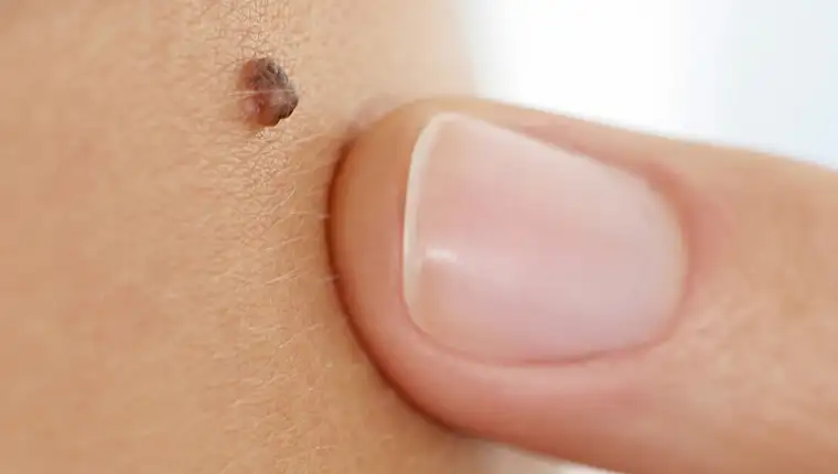 Beauty spot