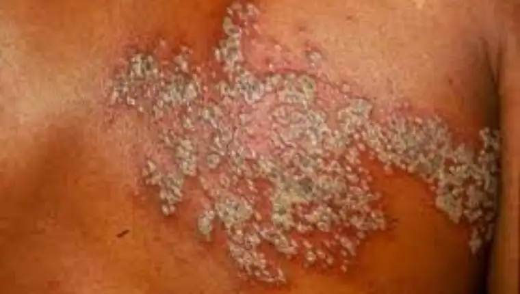 herpes zoster