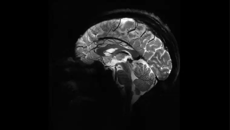 mozak mri