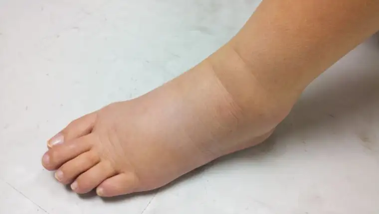 Gross,Edema,Of,Leg,And,Foot