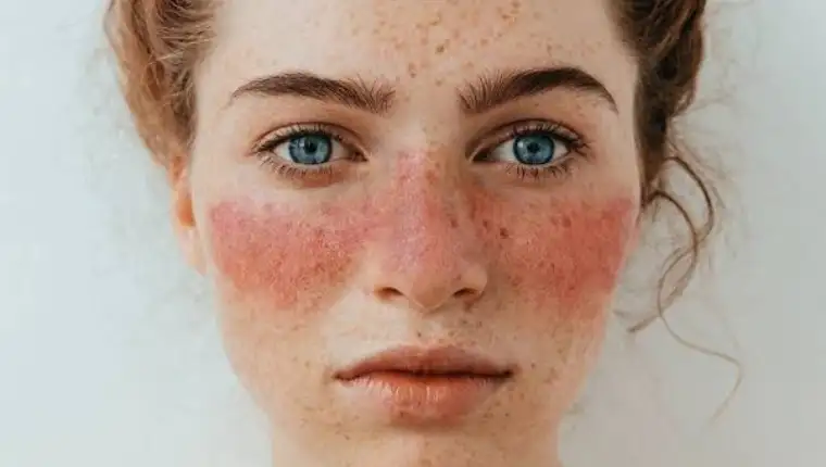 lupus bolest