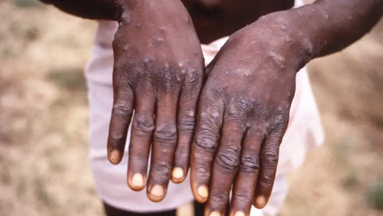 mpox