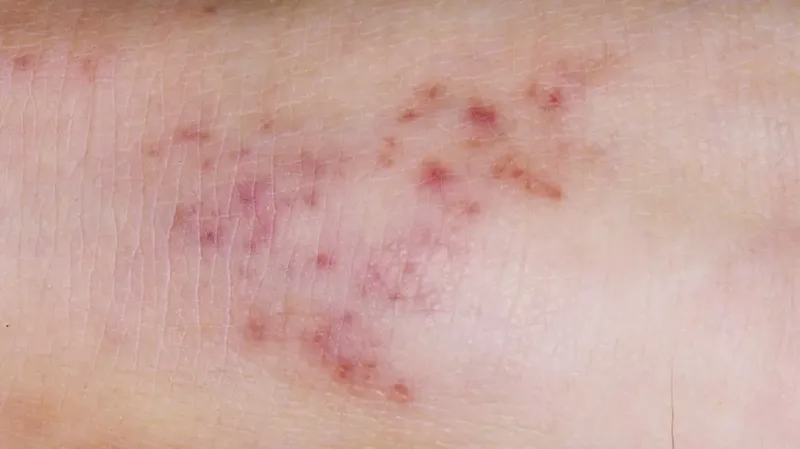 meningitis