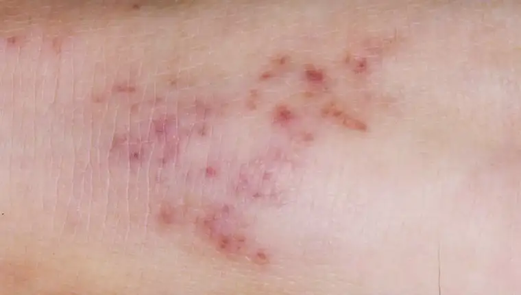 meningitis