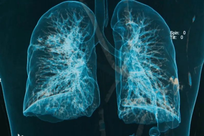 silikoza respiratorna bolest