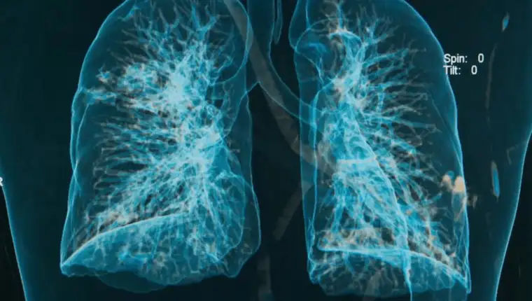 silikoza respiratorna bolest