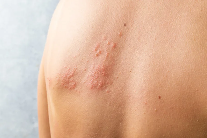 Skin infected Herpes zoster virus. Herpes Virus on body. urticaria rash. atopic dermatitis on body