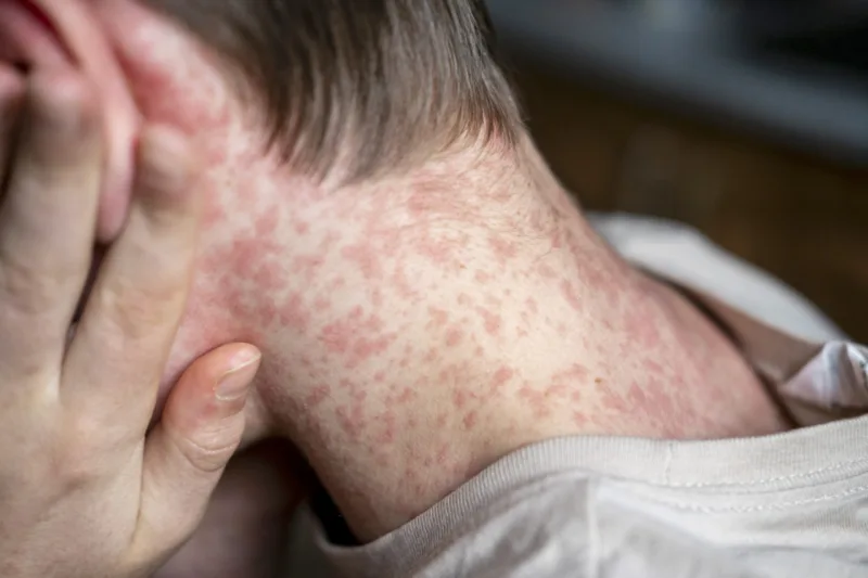 white Teenager covered in measles rash, infectious diseases.