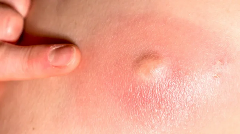 tvrda kvržica ispod kože