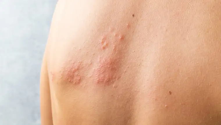 Skin infected Herpes zoster virus. Herpes Virus on body. urticaria rash. atopic dermatitis on body