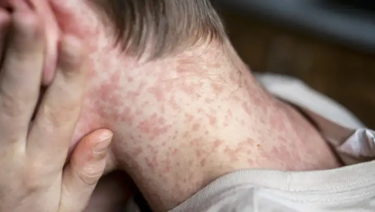 white Teenager covered in measles rash, infectious diseases.