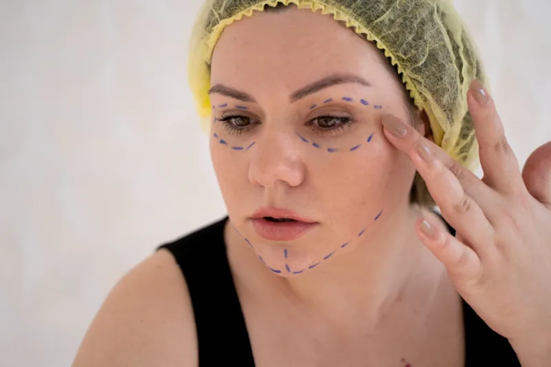 Facelifting