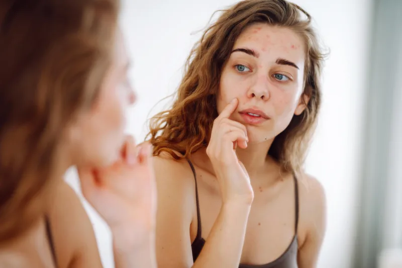 hormonalne akne freepik