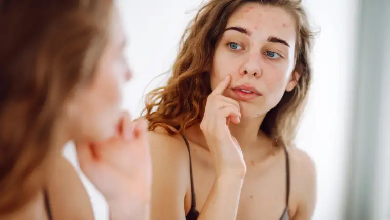 hormonalne akne freepik