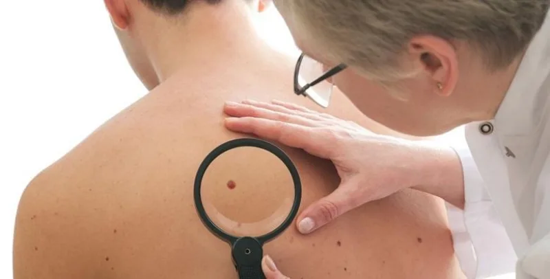pregled madeža dermatolog