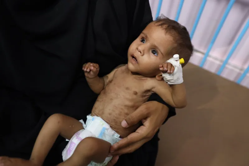 Izgladnjela jednoipogodišnja palestinska beba bori se za život