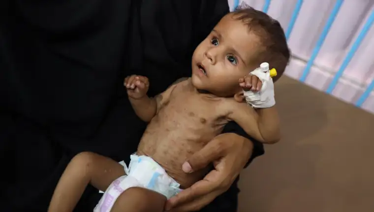 Izgladnjela jednoipogodišnja palestinska beba bori se za život