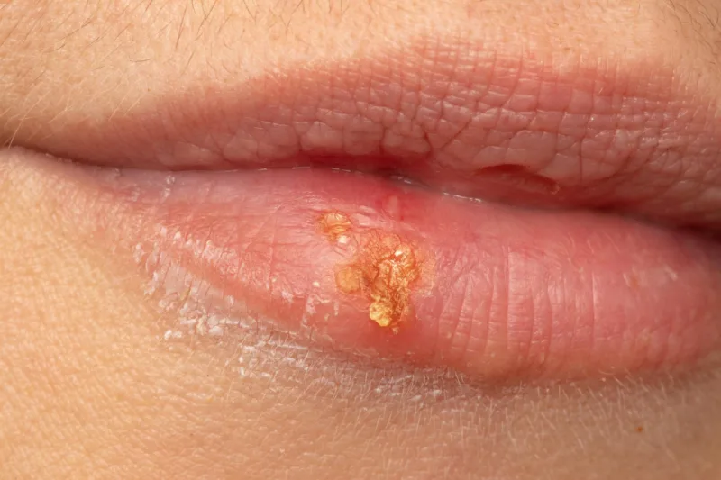 herpes freepik