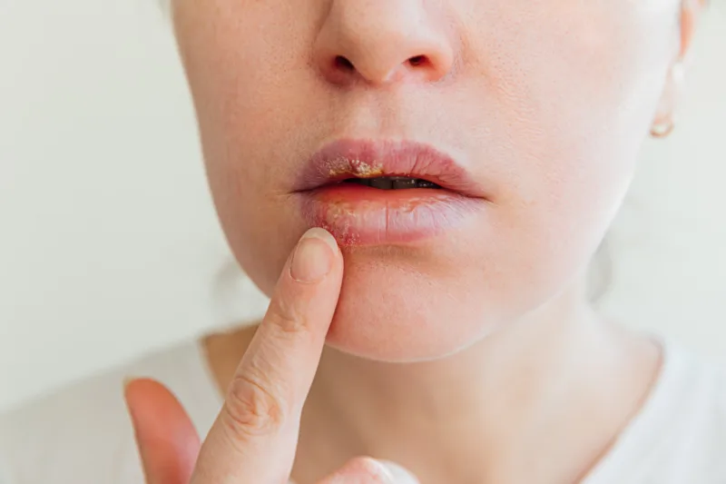 herpes freepik