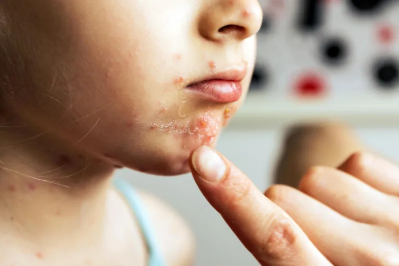 Impetigo freepik