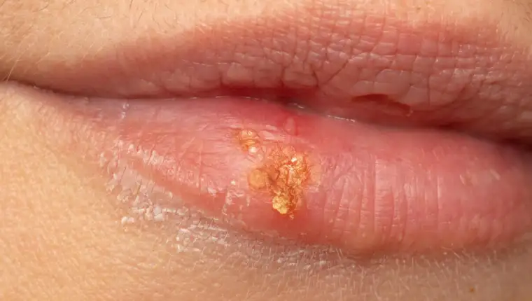 herpes freepik