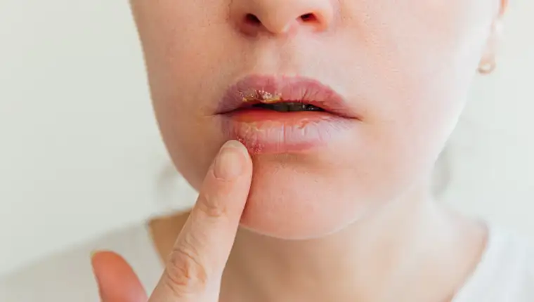 herpes freepik