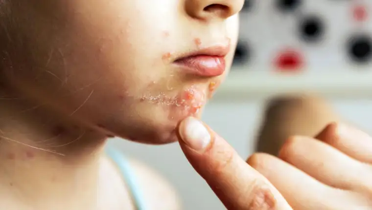 Impetigo freepik