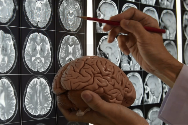 promjene u mozgu ljekar drži mozak i gleda rentgen
