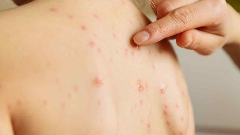 virusna zaraza osip na koži djeteta ruka